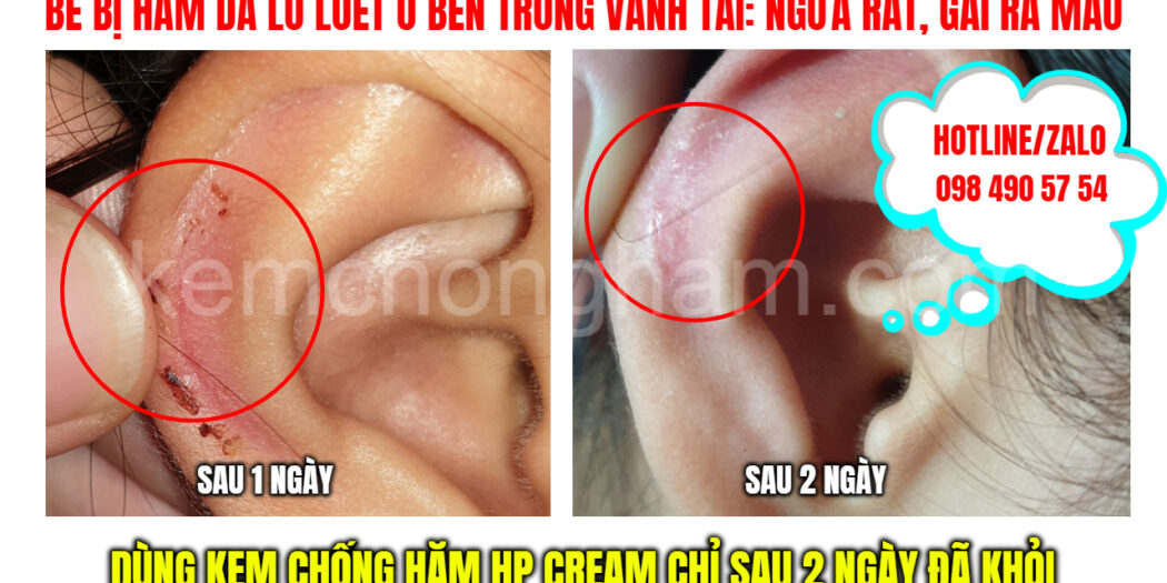 hăm da ở tai và cách điều trị hăm với kem chống hăm HP cream