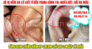 hăm da ở tai và cách điều trị hăm với kem chống hăm HP cream